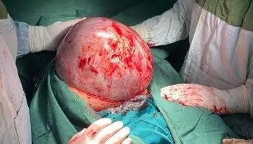 خارج کردن توده ۷.۵ کیلوگرمی از شکم زن تبریزی +عکس