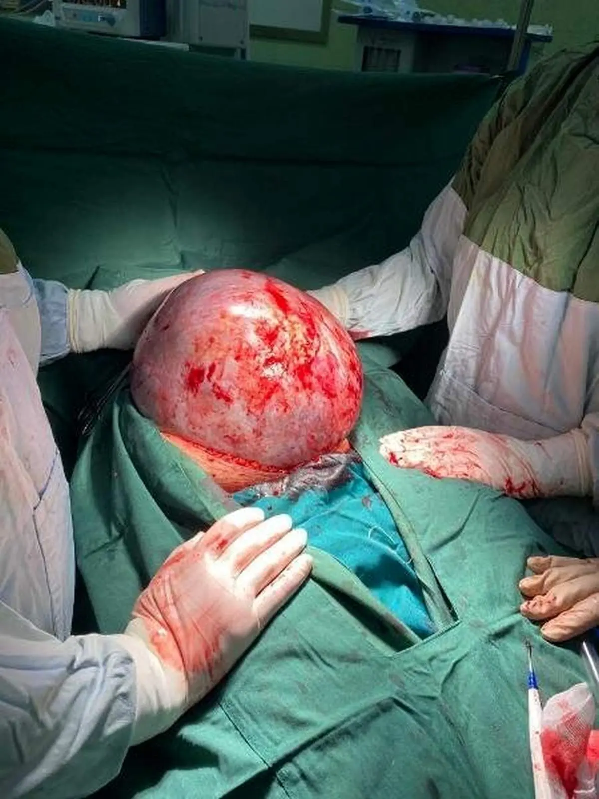 خارج کردن توده ۷.۵ کیلوگرمی از شکم زن تبریزی +عکس
