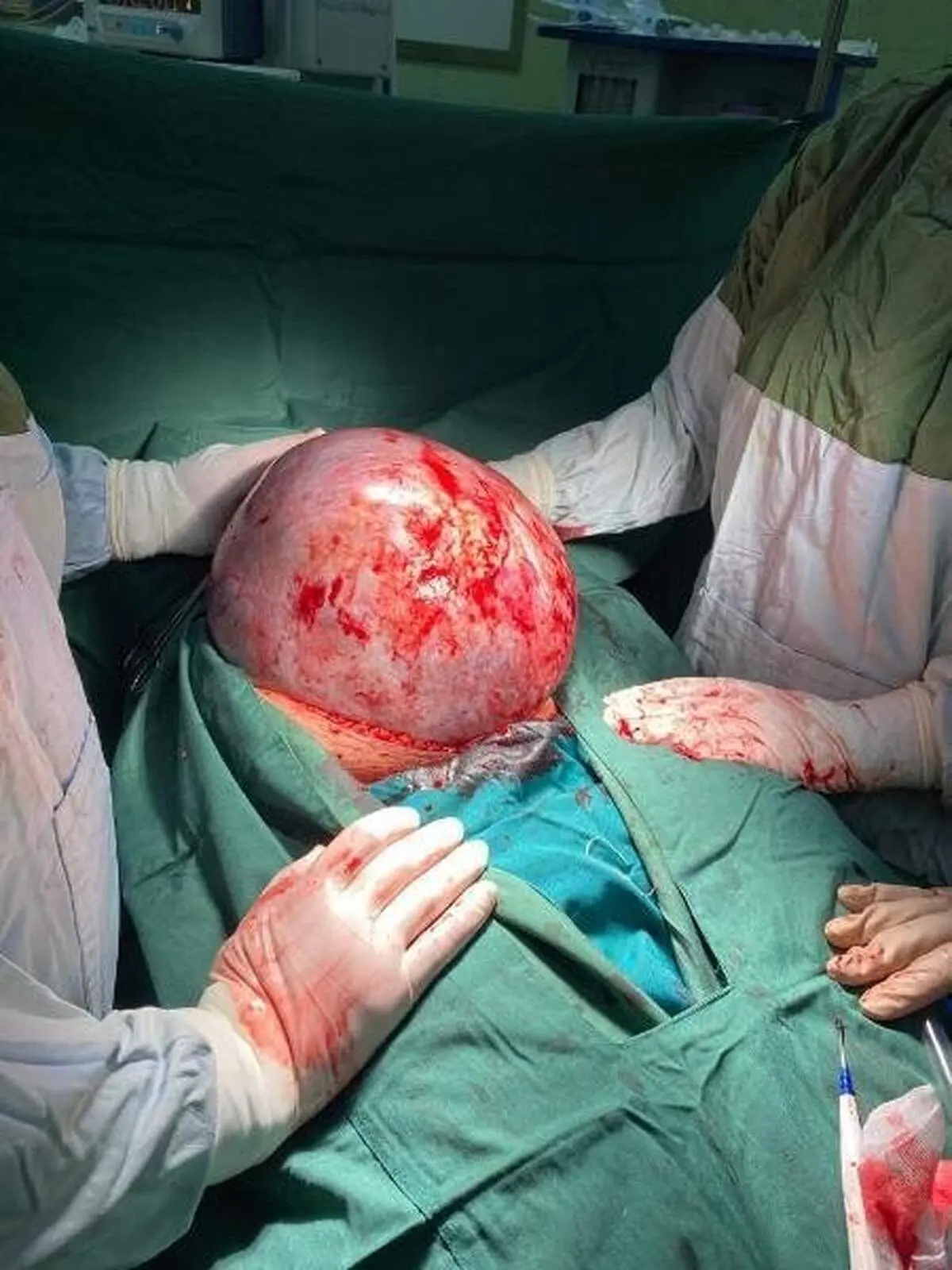 خارج کردن توده ۷.۵ کیلوگرمی از شکم زن تبریزی +عکس