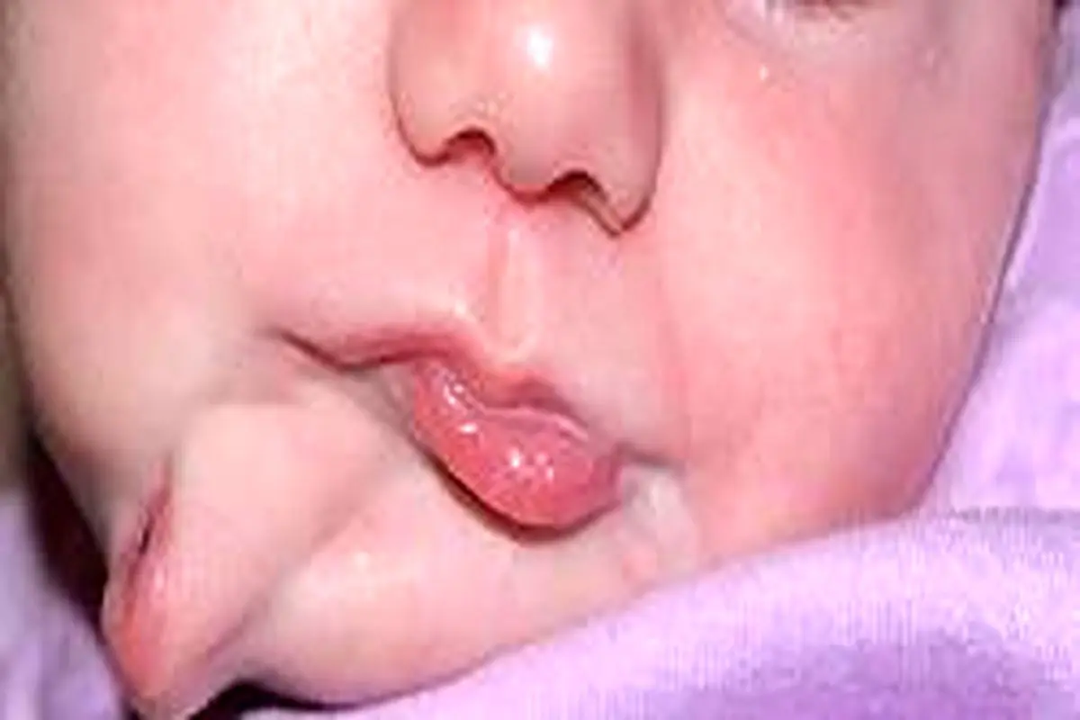 تولد یک نوزاد با دو دهان مجزا + عکس