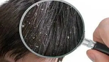علل به وجود آمدن شوره سر چیست؟