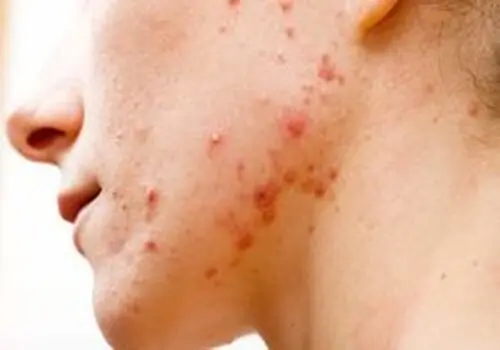 آبله مرغان تا چند روز واگیر دارد ؟