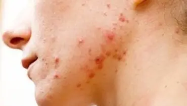 مهمترین علائم پوستی ابتلا به کرونا