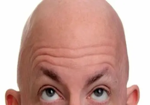 وداع با طاسی؛ کشف داروی جدید برای رفع طاسی مردانه