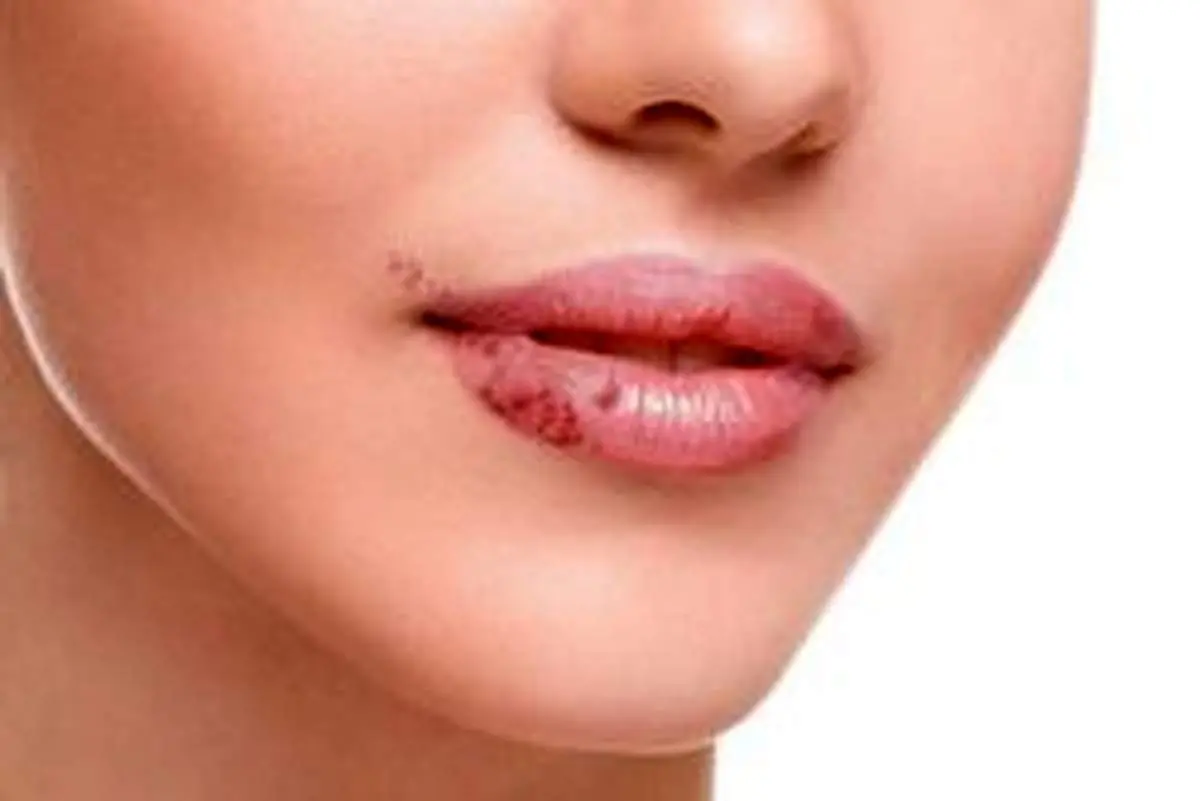 علل بروز سرطان لب / مهم‌ترین علائم سرطان لب