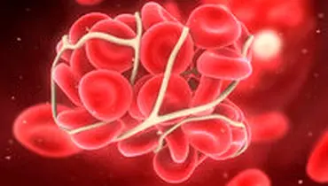 علائم لخته شدن خون چیست؟