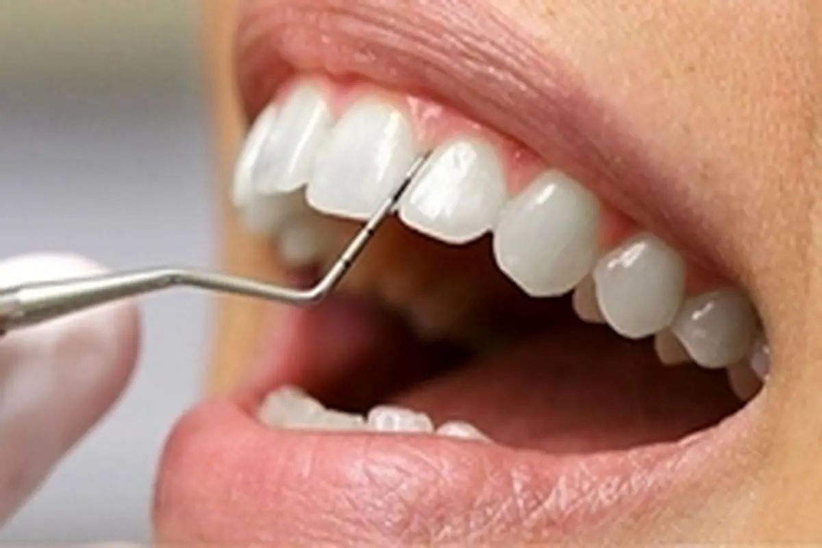 آیا جرم گیری برای دندان‌ها مضر است؟