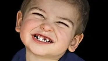 چرا کودکم دندان قروچه می کند؟ / عوارض دندان قروچه