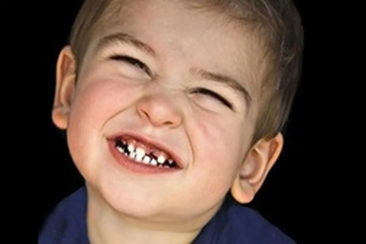 چرا کودکم دندان قروچه می کند؟ / عوارض دندان قروچه