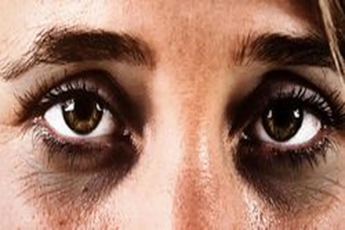 علل سیاهی زیر چشم چیست؟