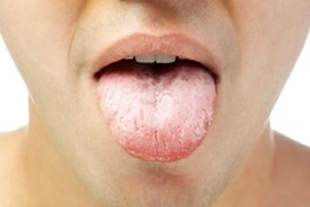 علل مختلف خشکی دهان چیست؟