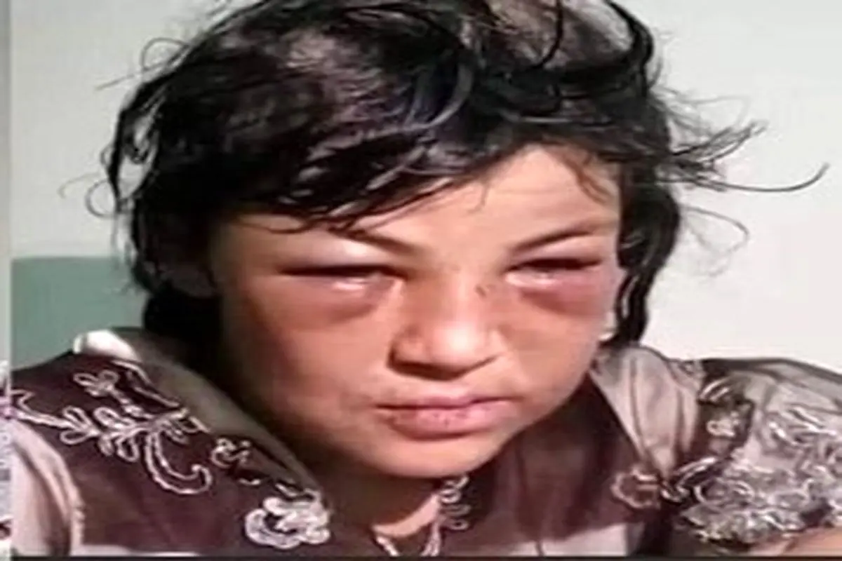 شکنجه وحشیانه زلیخای ۱۶ ساله توسط داماد ۴۳ ساله + عکس دلخراش