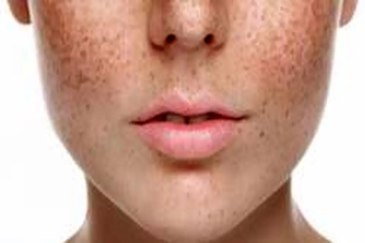 علت بروز لکههای قهوهای صورت چیست؟