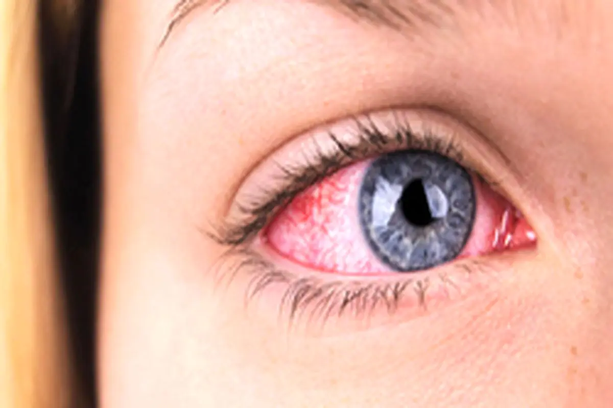 سه روش درمان قرمزی چشم