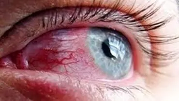 عوارض مواد ضدعفونی کننده بر روی چشم
