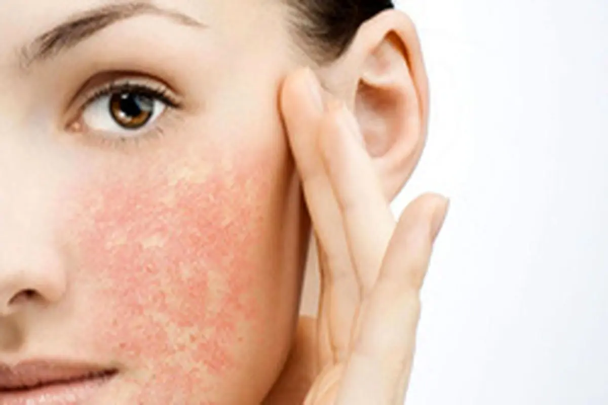 علت لکه‌های قهوه‌ای روی صورت/ وازلین بهترین راه برای درمان خشکی