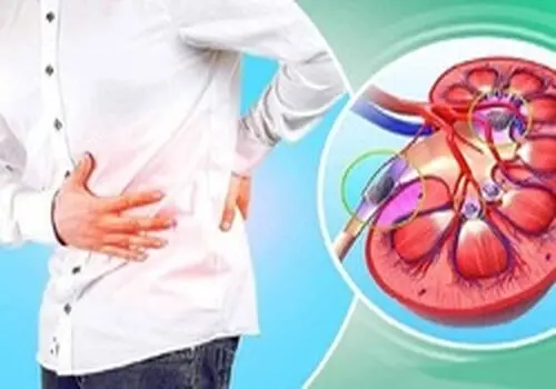 تاثیر لبنیات بر سنگ کلیه 