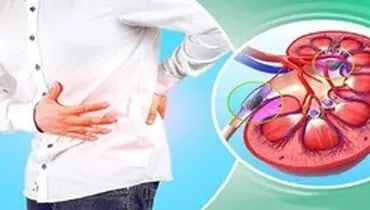 کاهش سنگ سازی کلیه با مصرف لبنیات