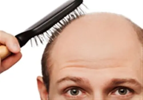 با شایع ترین علل ریزش مو آشنا شوید