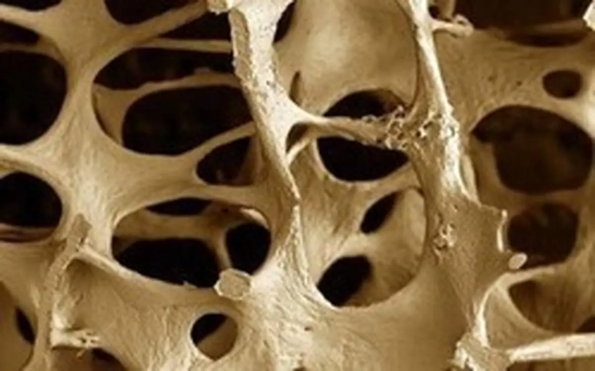 پوکی استخوان در کمین مبتلایان به دیابت نوع ۲