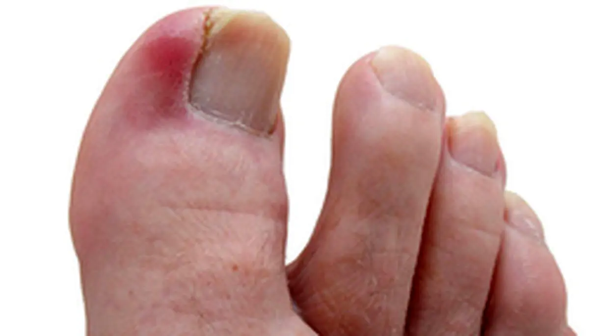 علت درد انگشت شست پا