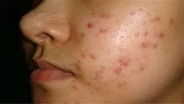 چگونه از لک‌های آکنه پیشگیری کنیم؟