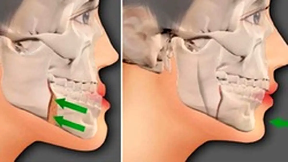 عوارض جراحی فک چیست/ فک طبیعی چه فکی است؟