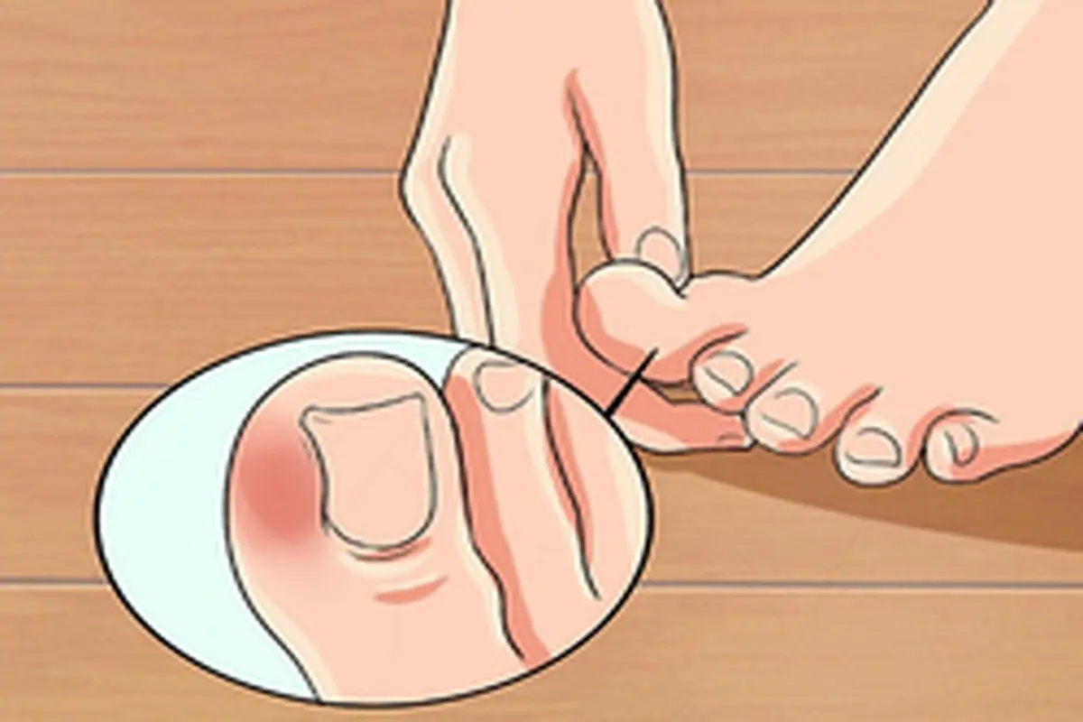 روش‌های درمان عفونت در انگشت پا