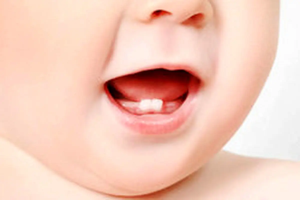 راهکارهایی برای جلوگیری از پوسیدگی دندان