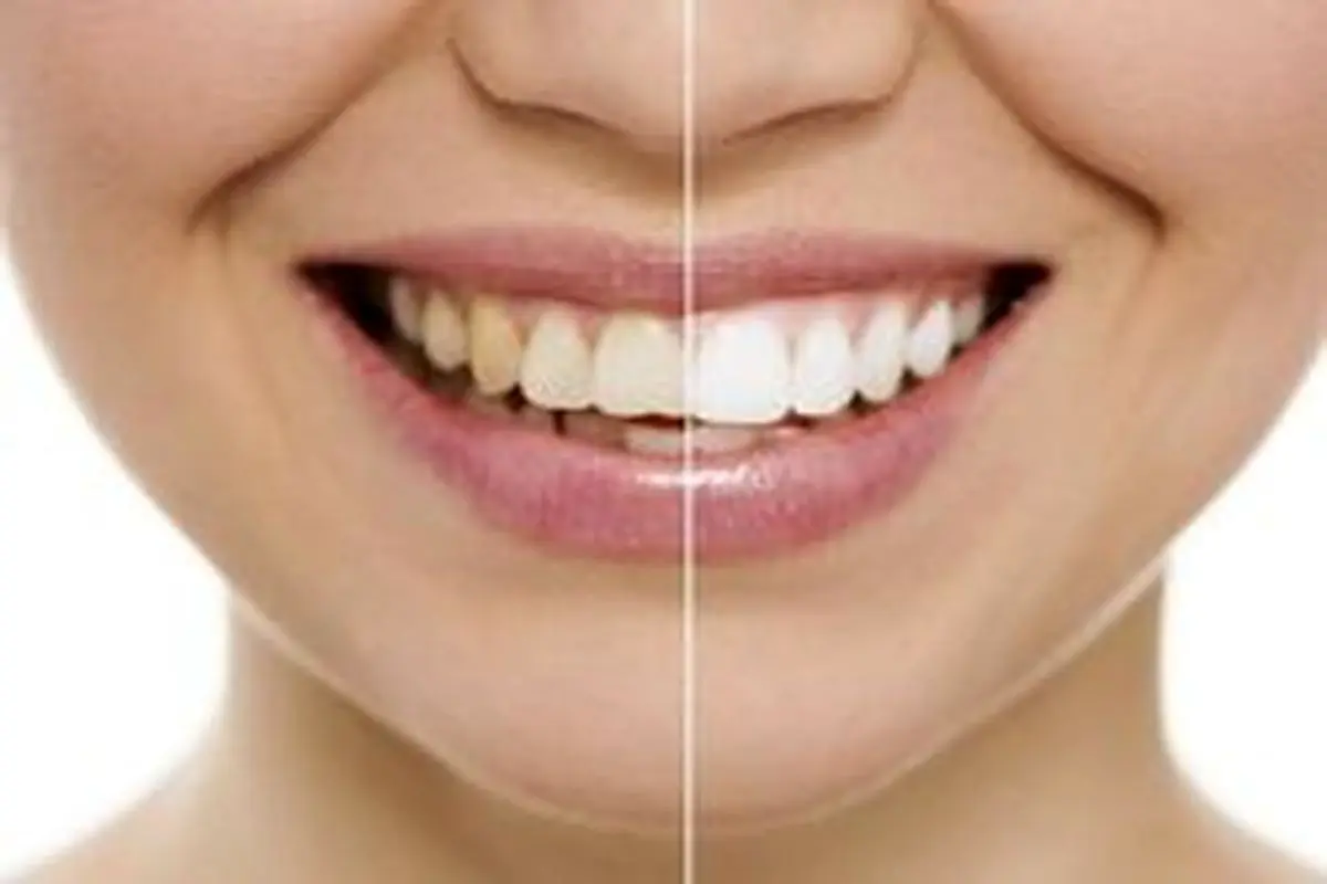 راه های طبیعی و ارزان برای سفید کردن دندان‌ها