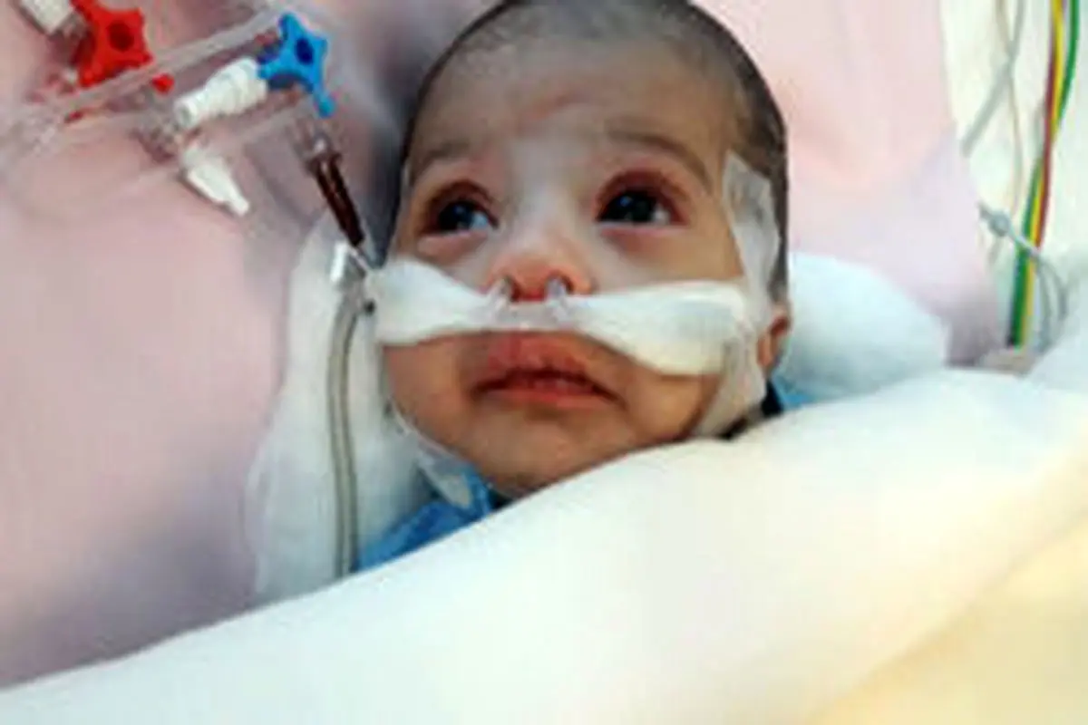 جراحی قلب باز نوزاد ۲۶ روزه در مشهد با موفقیت انجام شد + عکس