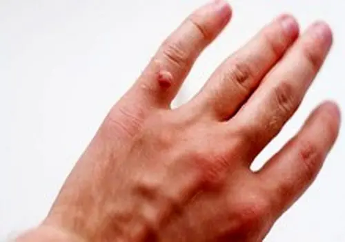 تفاوت خال گوشتی و زگیل چیست؟/ آیا کندن  زگیل با ناخنگیر یا بستن نخ خطرناک است؟
