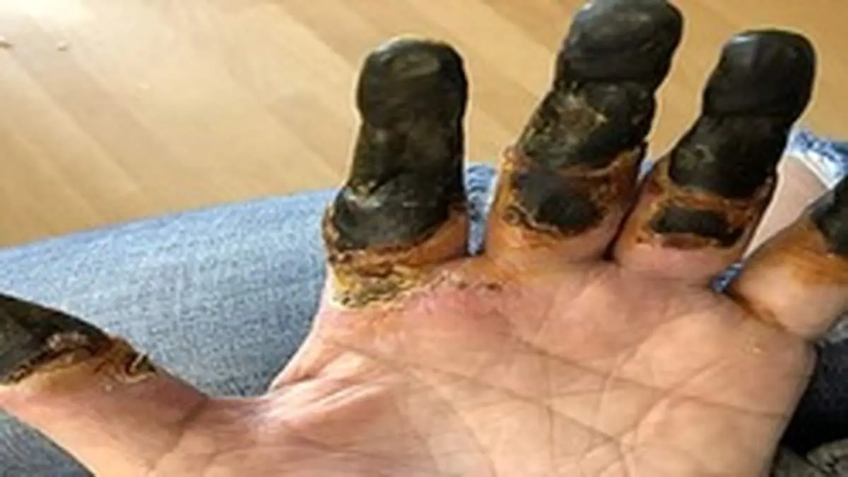 کرونا باعث قطع انگشتان یک مرد شد!