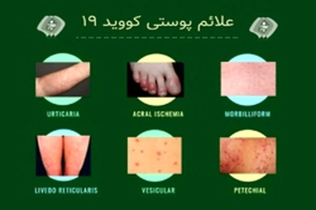 توجه به علائم پوستی در شرایط کرونایی