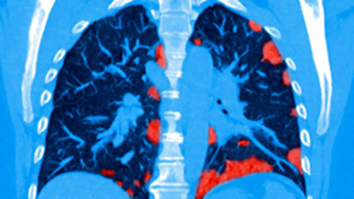 ویدئویی از تاثیر وحشتناک ویروس کرونا بر ریه‌ بیماران