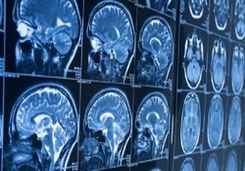 در تومور مغزی کجای سردرد میگیرد ؟ هرآنچه باید بدانید
