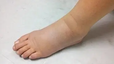 ۵ نشانه احتباس مایع در بدن