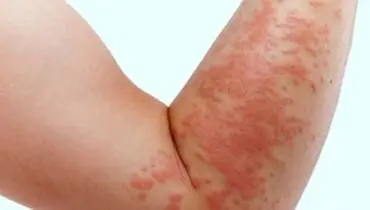 آیا استرس باعث بروز کهیر می شود؟
