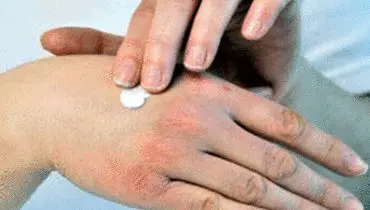 روش‌های ساده برای جلوگیری از خشکی پوست