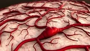 نشانه‌های ابتلا به آنوریسم مغزی