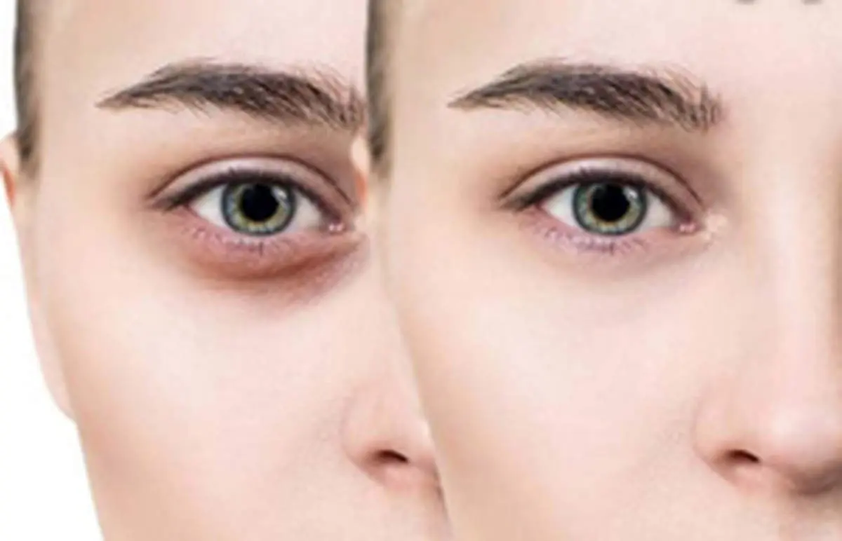 راهکارهای طبیعی برطرف کردن تیرگی دور چشم