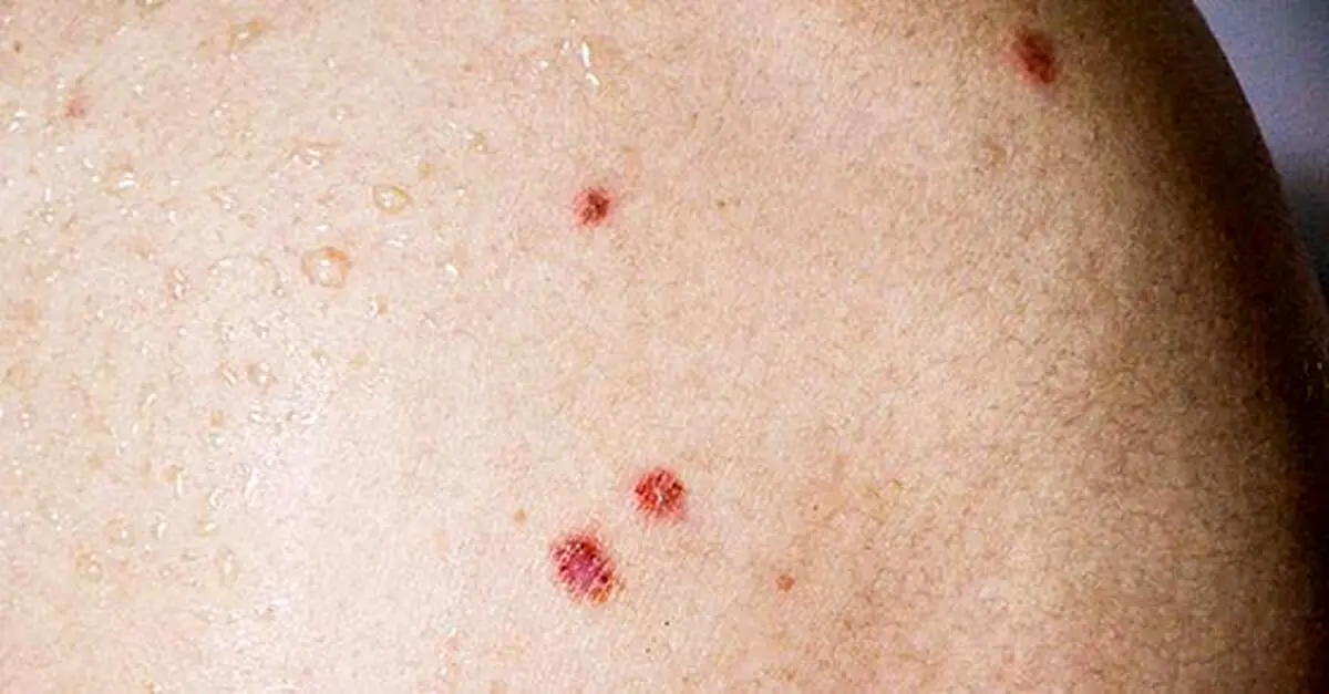 همه چیز در مورد بیماری بوون
