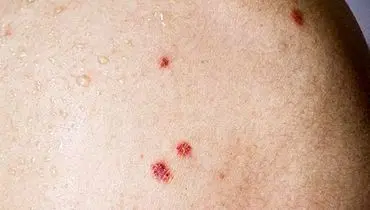 همه چیز در مورد بیماری بوون
