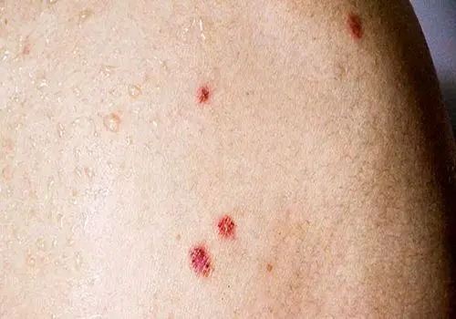 همه چیز در مورد بیماری بوون
