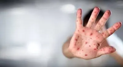 آبله‌مرغان در بزرگسالان چقدر خطرناک است؟

