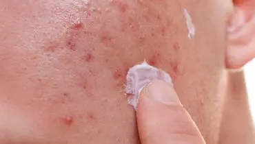 چطور بدون هزینه زیاد از لک های پوستی پیشگیری کنیم؟ + چند راهکار ساده اما موثر!
