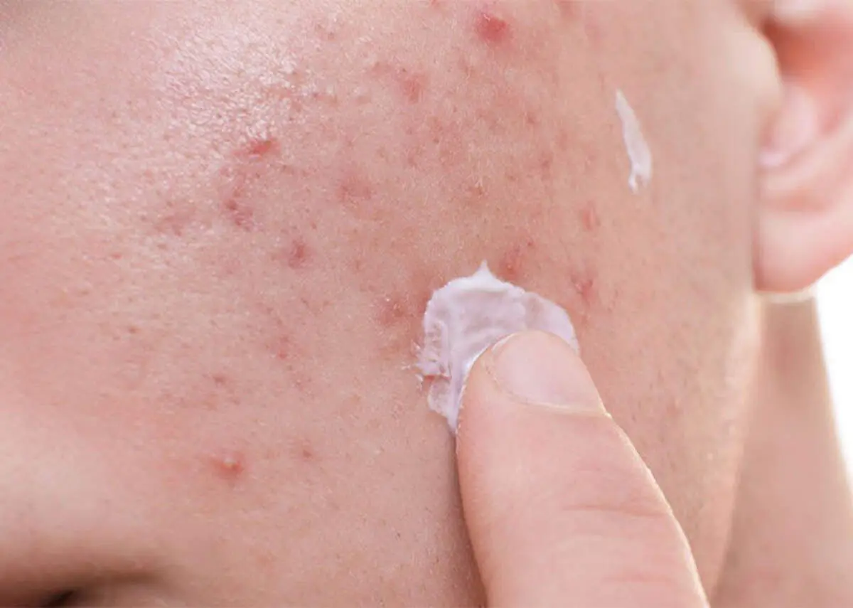 چطور بدون هزینه زیاد از لک های پوستی پیشگیری کنیم؟ + چند راهکار ساده اما موثر!
