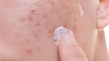 چطور بدون هزینه زیاد از لک های پوستی پیشگیری کنیم؟ + چند راهکار ساده اما موثر!
