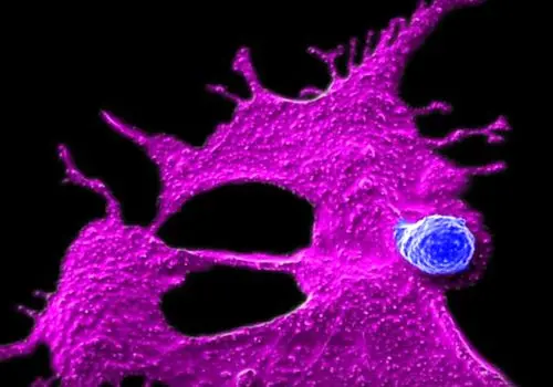 امید تازه در نبرد با سرطان پانکراس؛ درمان ایمنی سلولی محققان یو‌سی‌ال‌ای موفق شد تومورها را نابود کند