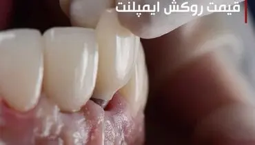 قیمت روکش ایمپلنت 1403